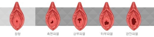 처녀막 파열 유형