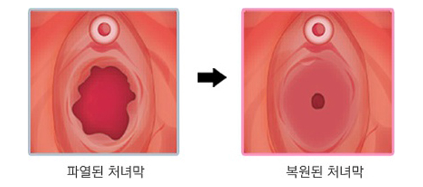 파열된 처녀막, 복원된 처녀막