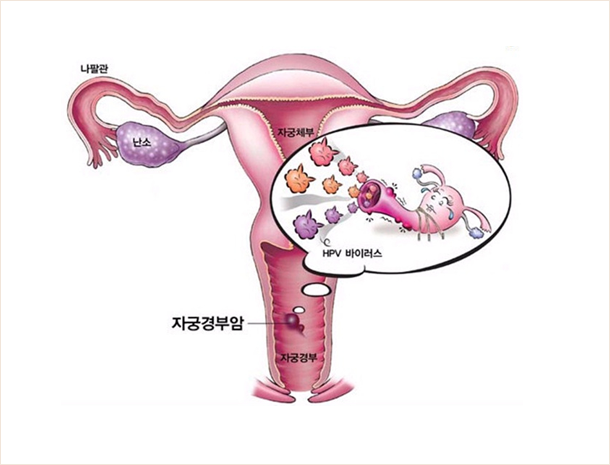 자궁경부암 이미지